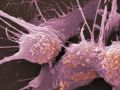 How Cancer Eats Itself To Survive Our Therapies