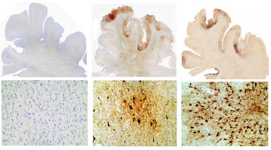 The healthy brain of a normal 65 year old, the brain of a former NFL linebacker, John Grimsley (who suffered 8 concussions and died at age 45), and the brain of a 73 year old boxer who suffered from an extreme form of dementia. Brown spots show concentrations of Tau protein, the more brown spots, the greater the brain damage. WBUR Boston's NPR/Flickr, CC BY