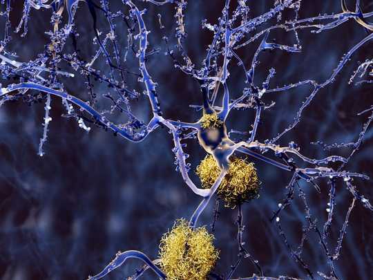 Rethinking The Approach To Fighting Alzheimer’s Disease