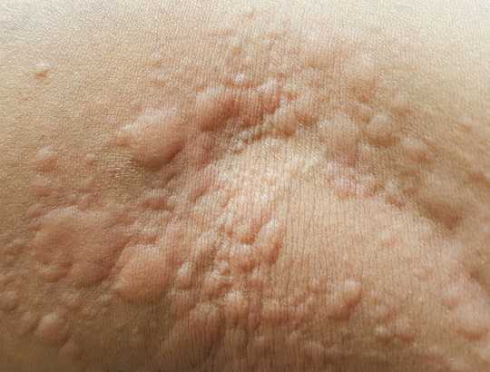 What Are Hives, The Common Skin Condition That Gives You Itchy, Red Bumps?