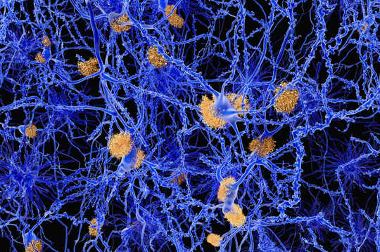 A computer illustration of amyloid plaques among neurons. Amyloid plaques are characteristic features of Alzheimer’s disease.