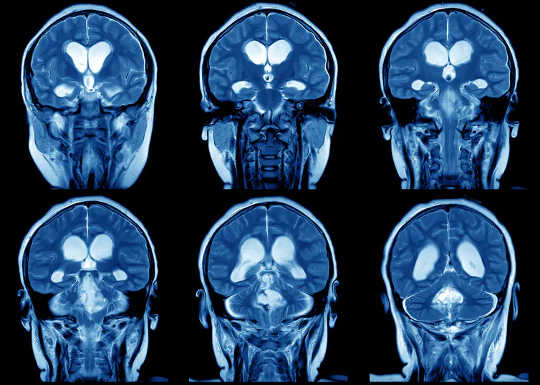 What Is Brain Plasticity and Why Is It So Important?