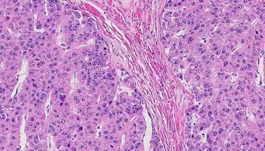 Fibrolamellar tumors cells show up as pink strands within a sea of smaller purple and pink dots
