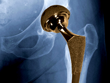 Graphic of hip showing metal-on-metal implant.